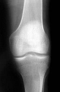 CBD Cream For Arthritis CBD Cream For Arthritis